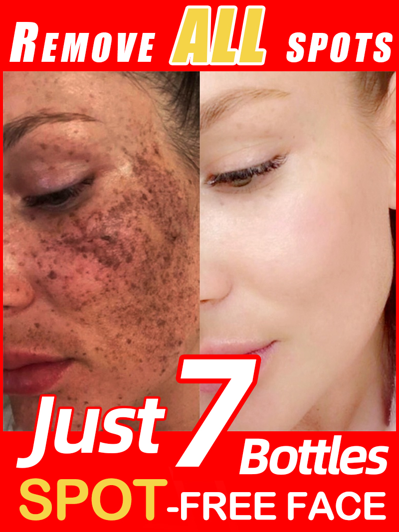 Ultra Luxury Skincare - Erhellen Sie Sommersprossen Melasma, dunkle Gesichtsflecken